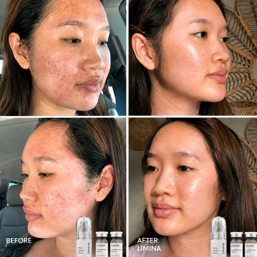 Limina Microneedling
