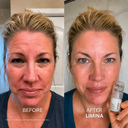 Limina Microneedling